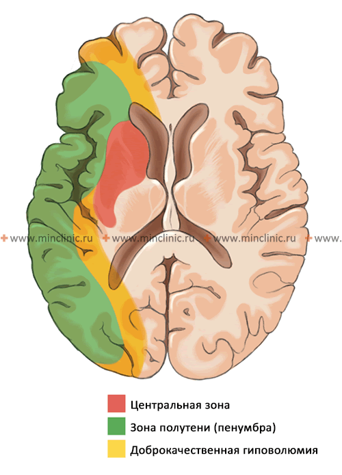 Эмболии сосудов головного мозга (церебральные эмболии) Схематическое изображение участков гипоперфузии (снижения кровотока) головного мозга после острой окклюзии средней мозговой артерии: центральная или ядерная зона инсульта (является зоной необратимой ишемии и гибели клеток), зона ишемической полутени или пенумбра (потенциально жизнеспособные нервные ткани при своевременном восстановлении кровотока), зона доброкачественной гиповолюмии (снижен мозговой кровоток, но нет риска гибели нервных клеток, независимо от лечения).